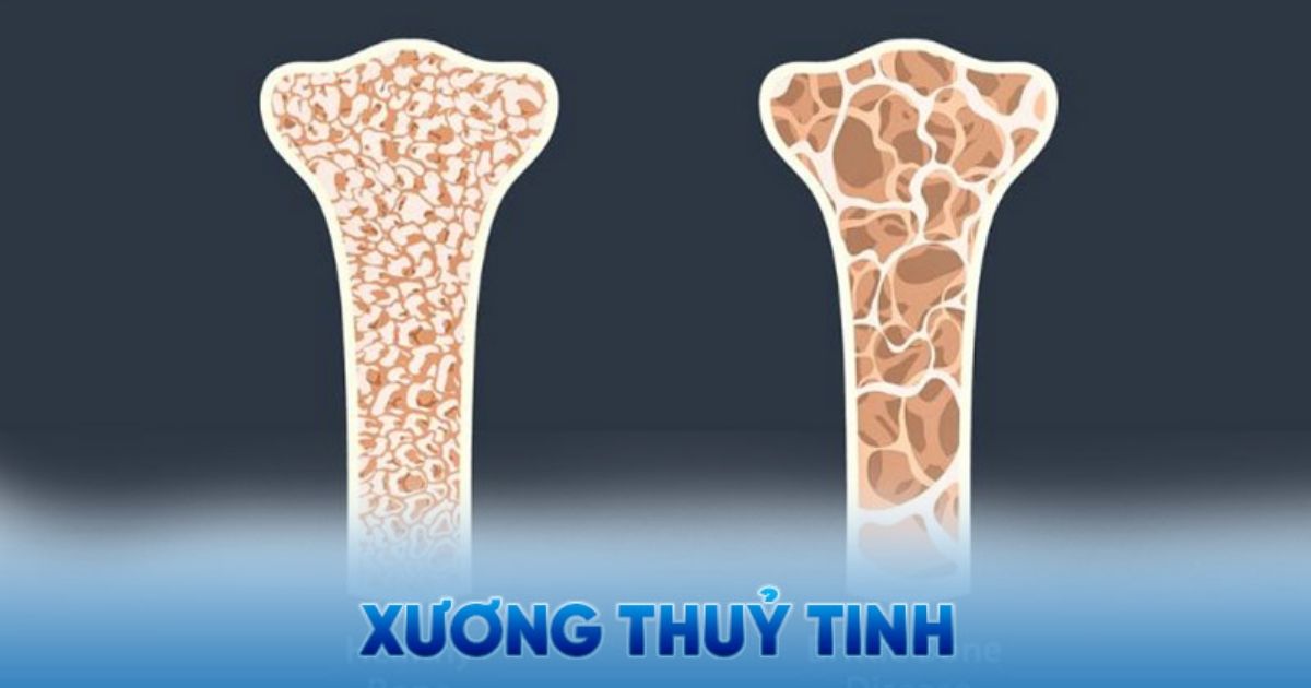 Bệnh Xương Thủy Tinh