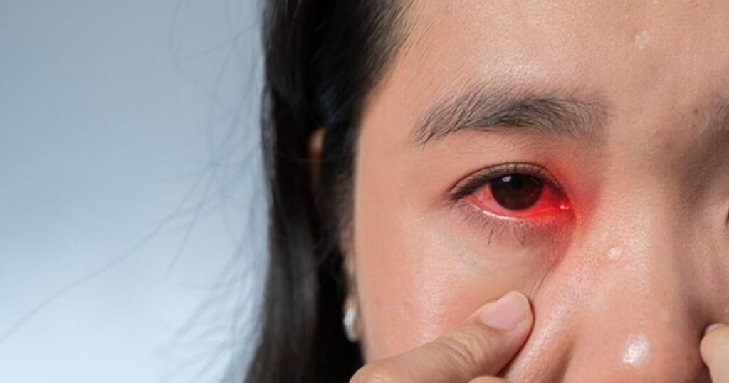 Bệnh đau mắt đỏ là gì và cơ chế lây lanBệnh đau mắt đỏ là gì và cơ chế lây lan
