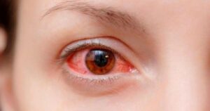 Các triệu chứng của bệnh đau mắt đỏ