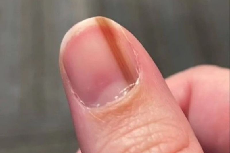 Khi nào móng tay có sọc nâu mờ cần được chú ý?