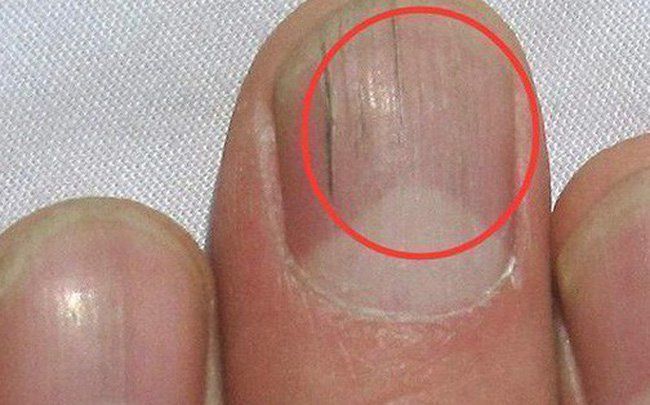 Móng tay có sọc nâu mờ nên chăm sóc thế nào?