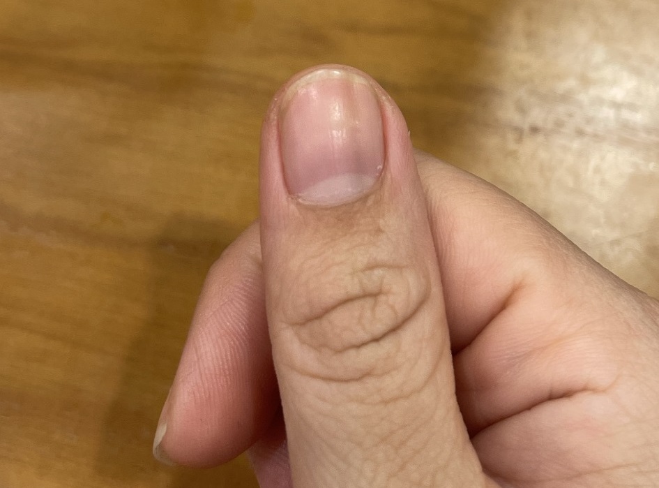 Móng tay có sọc nâu mờ: Nguyên nhân và khi nào cần khám